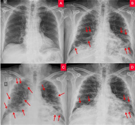 The Role Of Chest X Ray In Monitoring Lung Changes Among Covid 19
