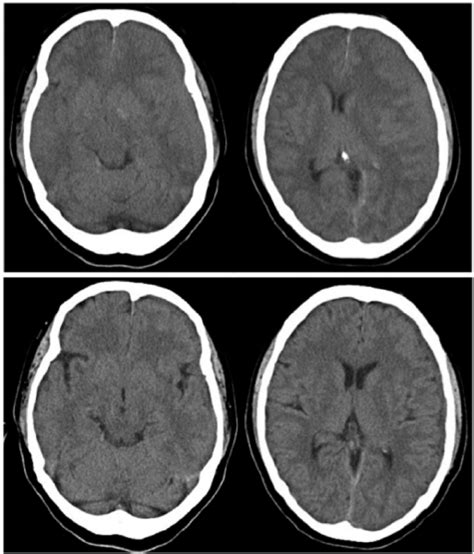 Brain Computed Tomography Showing Subdural Hematoma On The Left Side