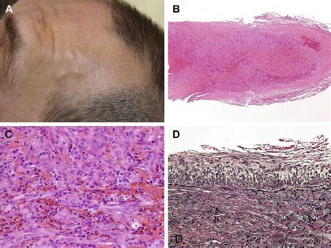 A Two Skin Colored Subcutaneous Nodules On The Left Temporal Area