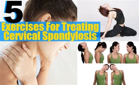 5 Effective Exercises For Treating Cervical Spondylosis Find Home