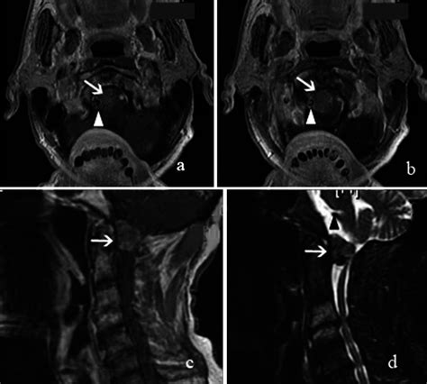 Preoperative Magnetic Resonance Imaging Of The Craniocervical Junction
