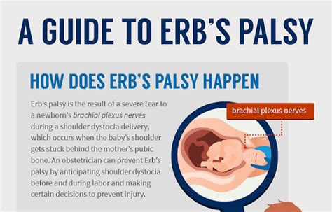 How Does Erbs Palsy Happen Infographic Visualistan