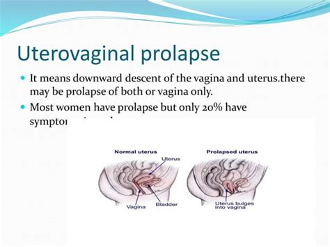 Uterovaginal Prolapse By Dr Zarkaish Ppt