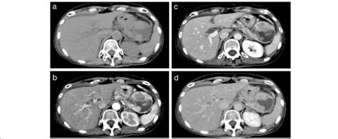 Dynamic Contrast Enhanced Computed Tomography Ct Findings A Plain Ct