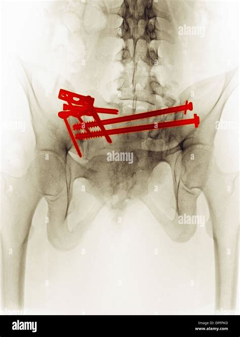 X Ray Montrant Une R Paration Chirurgicale De Fracture Du Bassin Photo