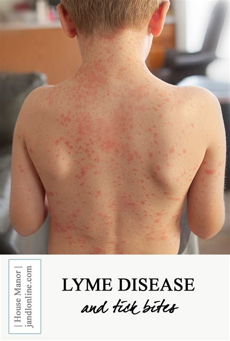 Lyme Disease Tick Bites Jandlonline