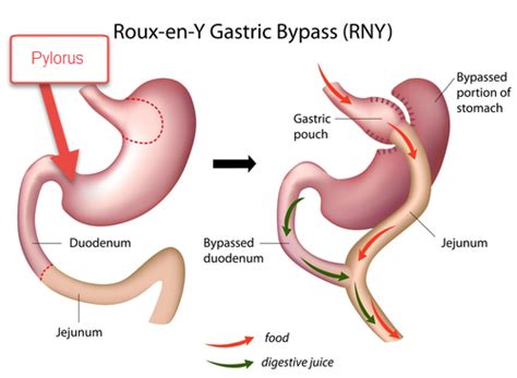The Experts Guide To Gastric Bypass