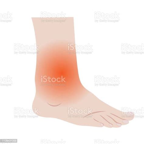 Swelling Of The Feet And Ankles From Infected Or Injury Stock