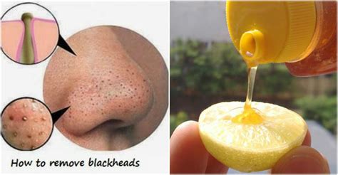 Home Remedies For Blackheads Slide Share
