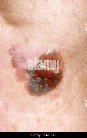 Melanoma Close Up Of A Malignant Melanoma Blemish On The Surface Of