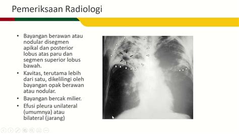 Tuberkulosis Youtube