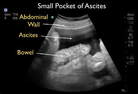 Ultrasound Small Pocket Of Ascites Download Scientific Diagram