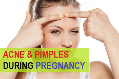 Best Treatment For Pimples And Acne During Pregnancy At Home