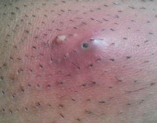 You can get deep ingrowing hairs in the pubic. Ingrown Hair on Scrotum, Testicle Sac, Symptoms, Pictures ...