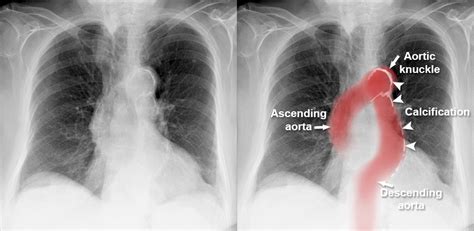 Chest X Ray Mediastinum And Hilum Aortic Unfolding