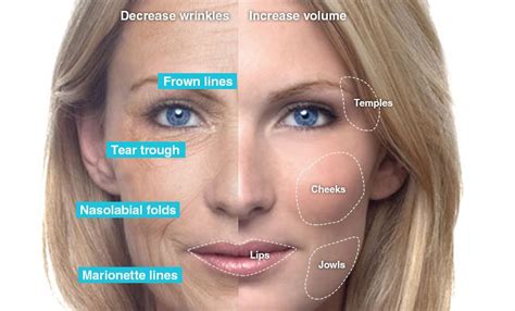 Botox® Cosmetic Is Commonly Used To Reduce Or Eliminate The Appearance