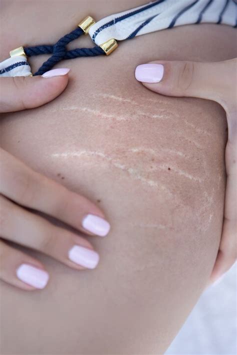 Tame Your Stretch Marks