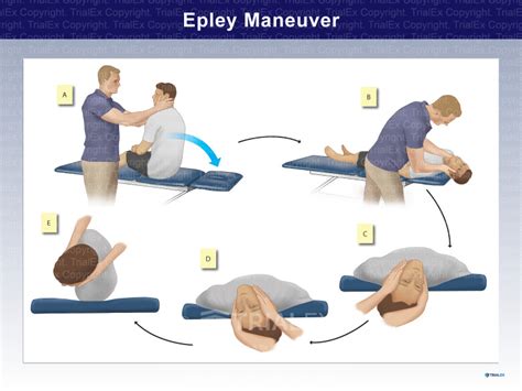 Epley Maneuver Illustration