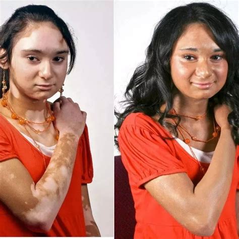 A Cure For Vitiligo New Us2000 Treatment Is Restoring Skin