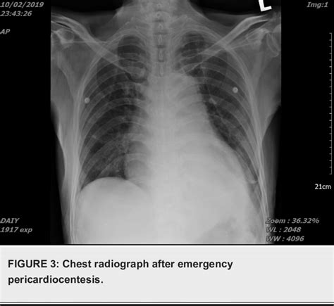 Chest Radiograph Upon Admission Showing Cardiomegaly Pulmonary