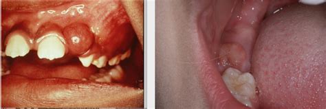 Eruption Cyst Odontogenic Developmental Diagram Quizlet