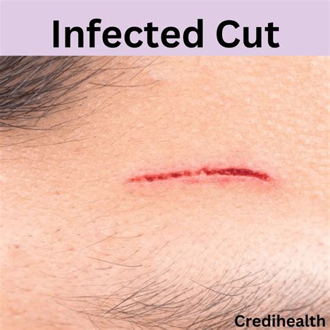 Infected Cut Pictures What They Look Like And How To Treat Them
