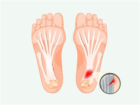 Plantar Fasciitis Diagnosis Causes Treatments