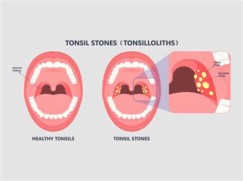 Bad Breath Sore Throat And Tonsil Stones Bergerhenry Ent Specialty Group