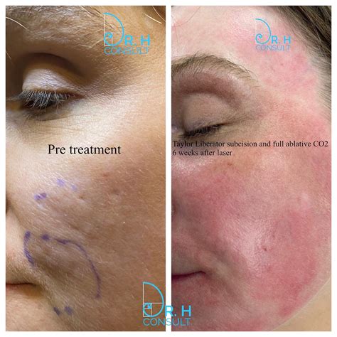 Fully Ablative Co2 Laser Resurfacing Treatment Dr H Consult