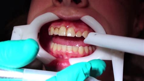 Gingival Recontouring Reshaping The Gum Tissue With A Laser Youtube