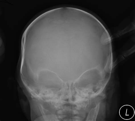 Non Traumatic Depressed Skull Fracture In A Neonate Or ‘ping Pong