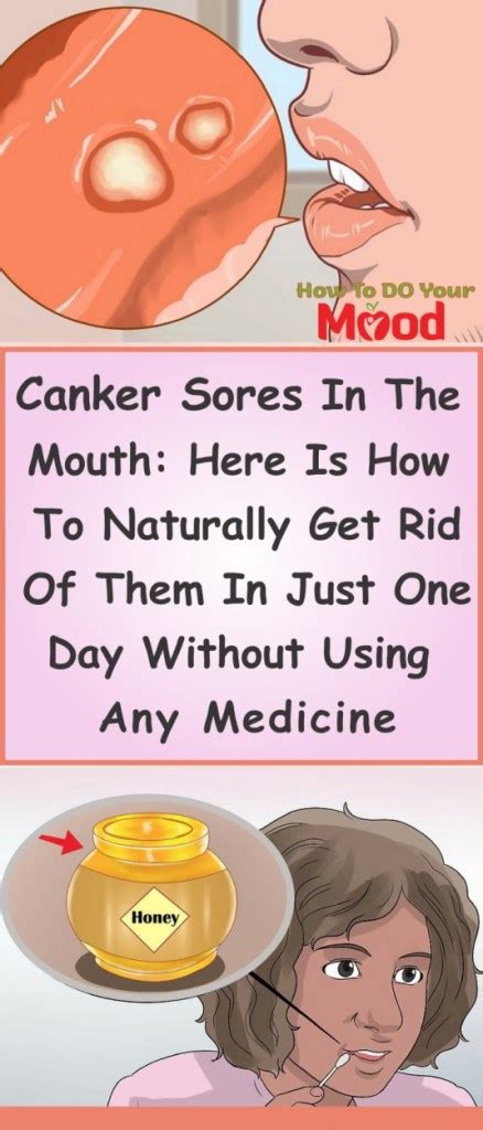 Canker Sores In The Mouth Here Is How To Naturally Get Rid Of Them In
