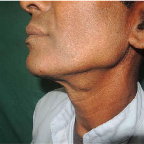 Lateral View Of The Left Side Of Neck Showing Swelling In Left