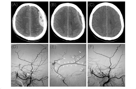 A Brain Computed Tomographic Hematoma Images For Patient 2 Before