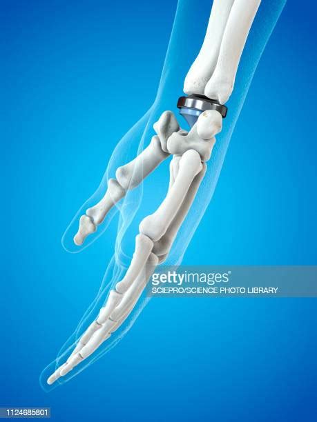 Arm Implant Photos And Premium High Res Pictures Getty Images