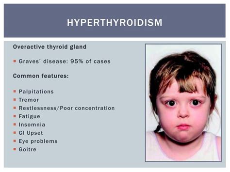 Hyperthyroidism And The Safety Of Radioiodine In Children