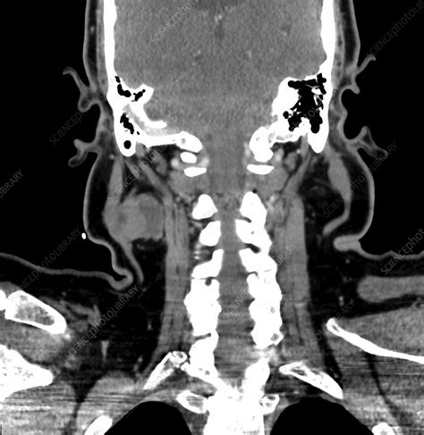 Metastatic Cervical Lymph Node Ct Scan Stock Image C0393529