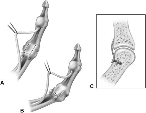 Volar Capsulodesis Of The Thumb Metacarpophalangeal Joint At The Time