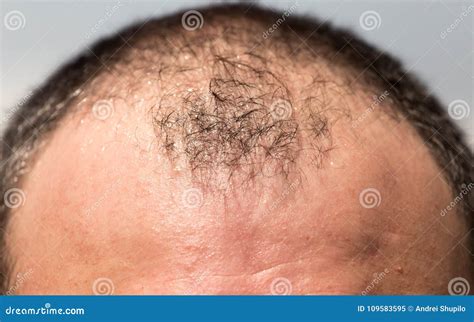 Bald Spots On The Head Of A Man Stock Image Image Of Treatment Head