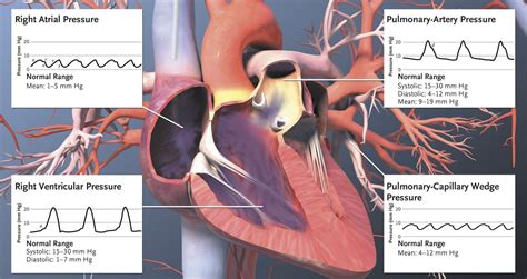 right heart cath pressure waveforms