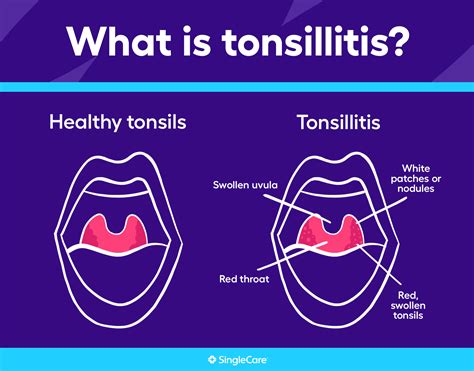 Tonsillitis Symptoms Causes And Treatments