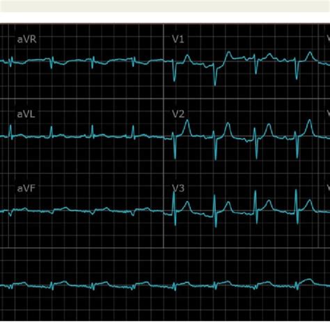 Electrocardiogram On Admission Suggestive Of A Lateral St Elevation