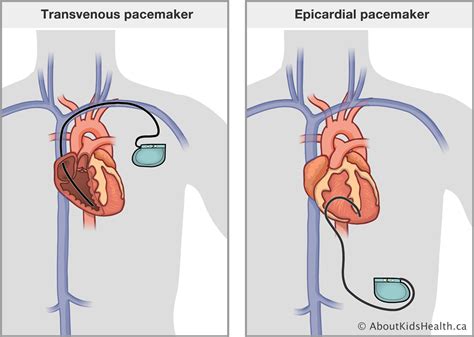 Pacemaker Caring For Your Child At Home
