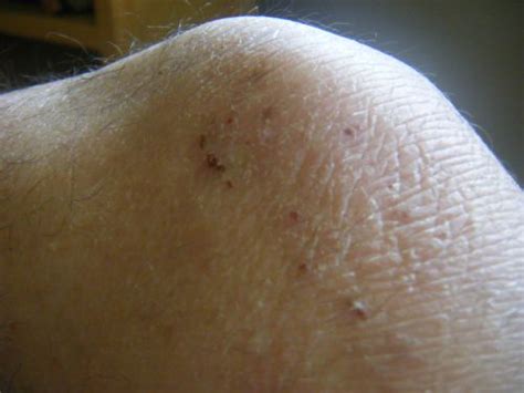 Eczema Pictures Pictures Of Eczema Natural Eczema Cure Revealed