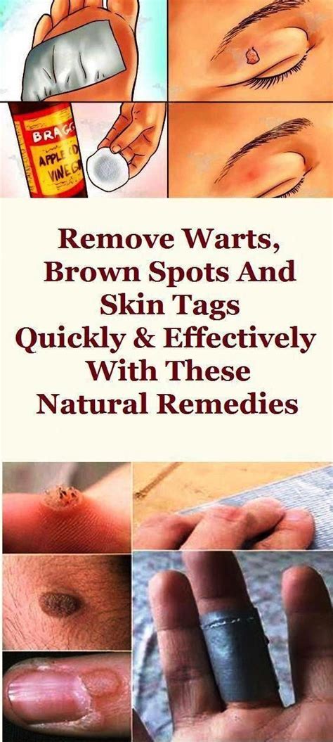 Pin On How To Remove Warts Fast