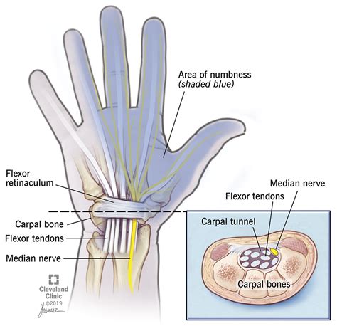 Carpal means wrist, in this case there is a tunnel through which run nerves. Carpal Tunnel Syndrome: Risk Factors, Symptoms & Treatment