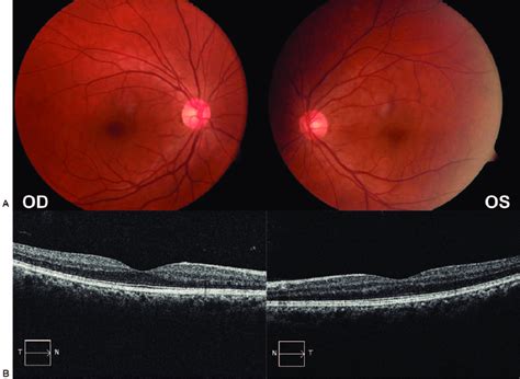 A Fundus Photography Showed Normal Optic Disc And Fundus In Both