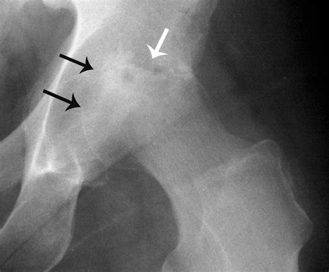 Septic Arthritis Of The Hip In An Immune Competent Adult The