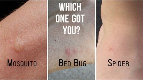 Bed Bug Rash Pictures Medical Pictures And Images 2021 Updated