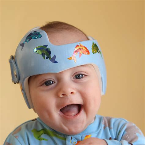 Helmet Therapy For Your Baby Johns Hopkins Medicine Health Library